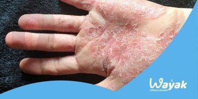 ما هي علامات شفاء الصدفية كارت وياك